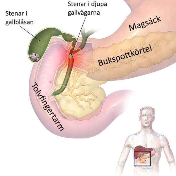 Tecknad bild på hur det ser ut när patienten behöver en galloperation.